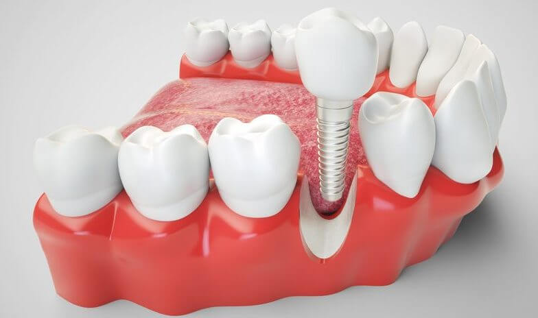 Dantų implantai Šiauliuose